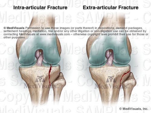 non articular