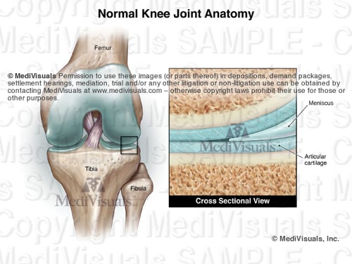 Intra Articular Fractures Explained