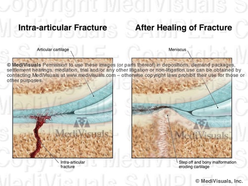 Image3 Frac AfterHealSTAMP