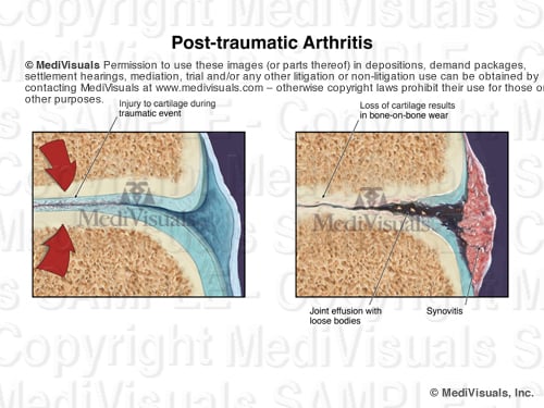 Image4 ArthriteSTAMPED2