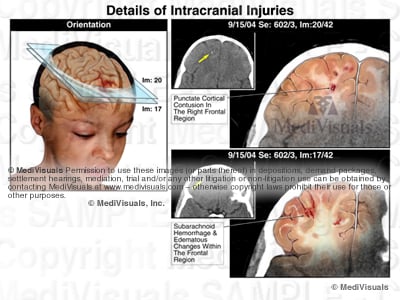 intracranial, ct scan, shear force, hemorrhage