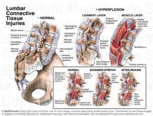 Soft Tissues of the Lumbar Spine