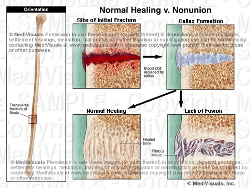 complications-associated-with-fracture-injuries