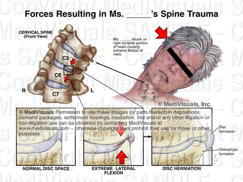 uncovertebral osteophytes