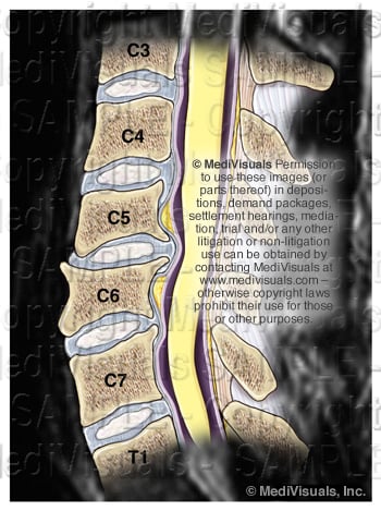 Sagittal Spine Osteophyte Disc