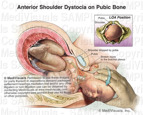 Shoulder Dystocia and Excessive Traction