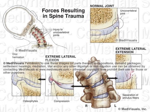 Spine Trauma Forces Osteophyte Disc