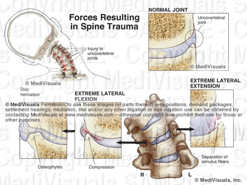 uncovertebral osteophytes