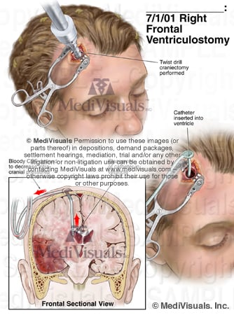 Ventriculostomy traumatic brain injury